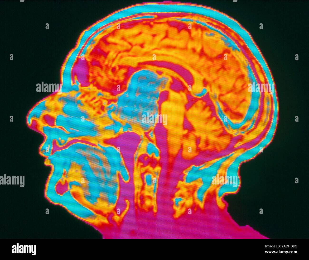 Pituitary tumour. Coloured Magnetic Resonance Imaging (MRI) scan of a ...