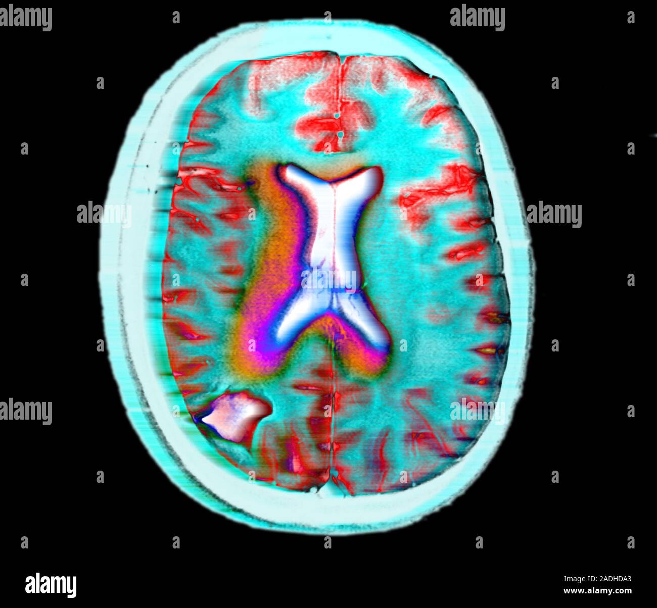 Brain cancer. Coloured magnetic resonance imaging (MRI) scan of an ...