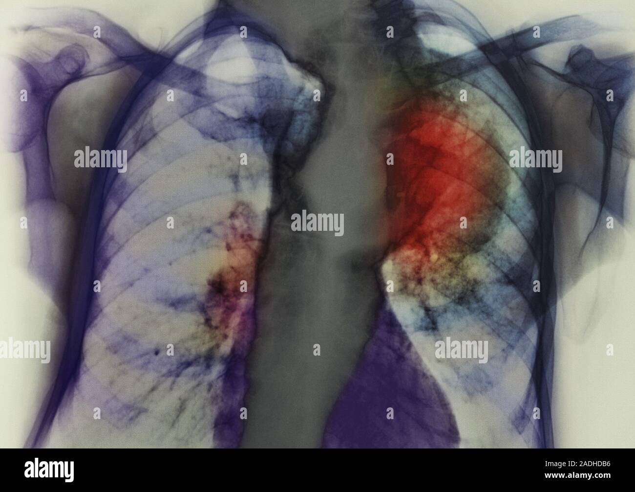 Lung cancer. Coloured chest X-ray of a 70 year old woman showing cancer ...