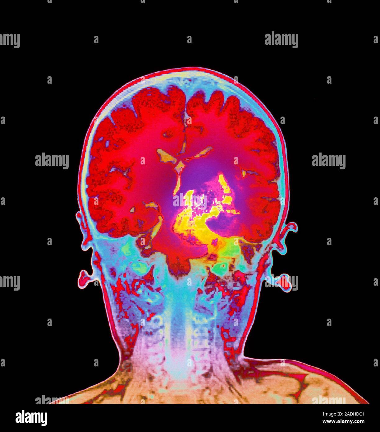 Brain cancer. Coloured magnetic resonance imaging (MRI) scan of a ...