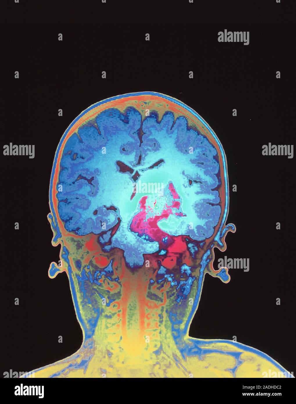 Brain cancer. Coloured magnetic resonance imaging (MRI) scan of a ...