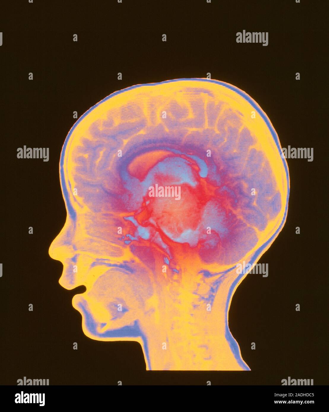 Brain cancer. Coloured magnetic resonance imaging (MRI) scan of a ...