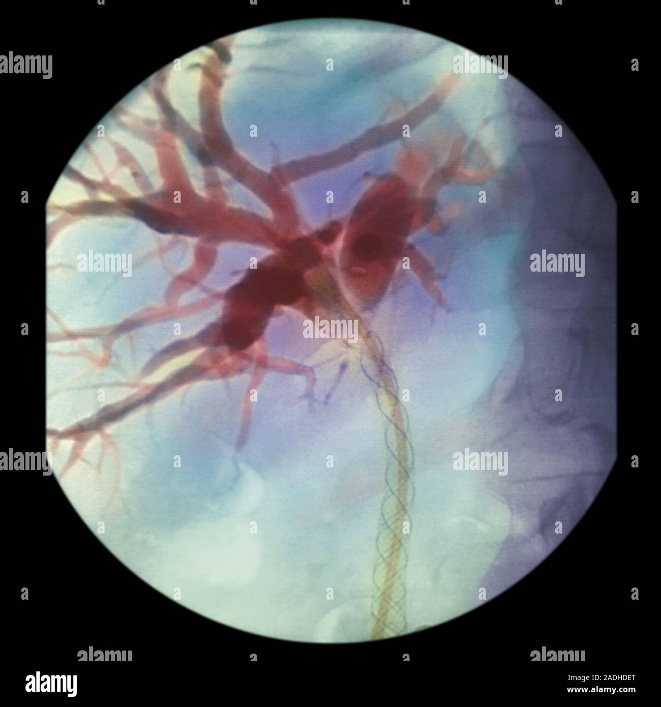 Biliary Angiogram Bile duct cancer. Coloured angiogram (X-ray) of a patient's common bile ...