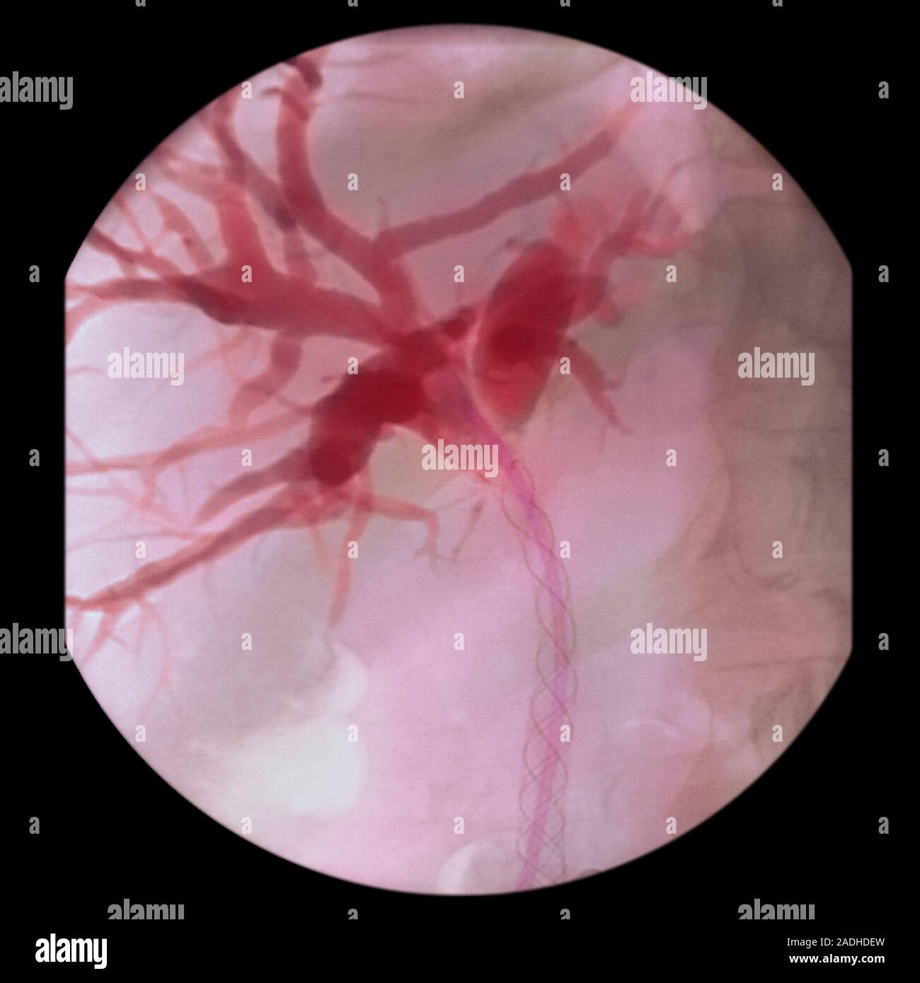 Biliary Angiogram Bile duct cancer. Coloured angiogram (X-ray) of a patient's common bile ...
