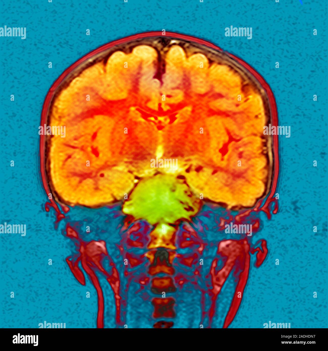 Brain cancer. Coloured magnetic resonance imaging (MRI) scan of a ...