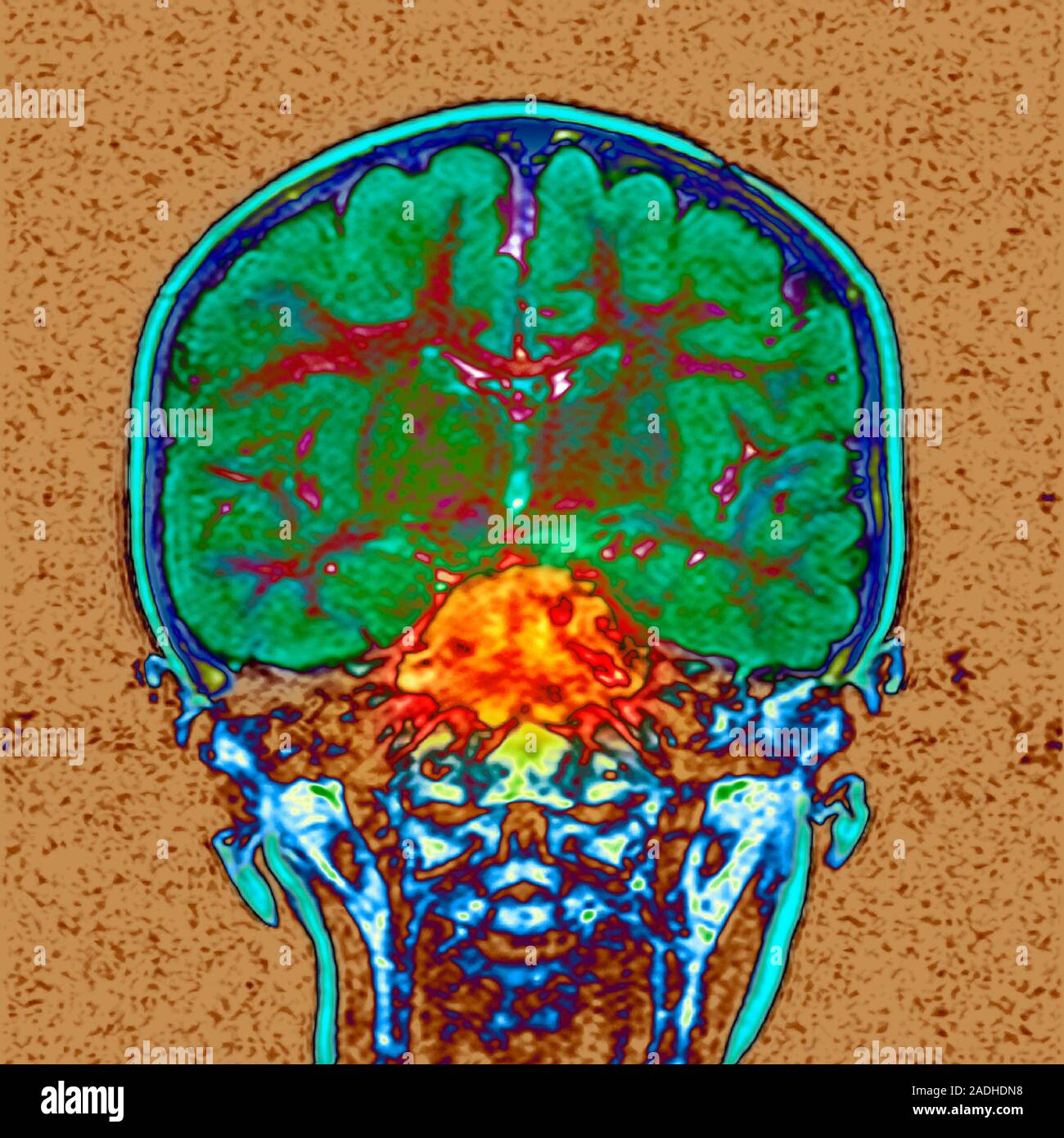 Brain cancer. Coloured magnetic resonance imaging (MRI) scan of a ...