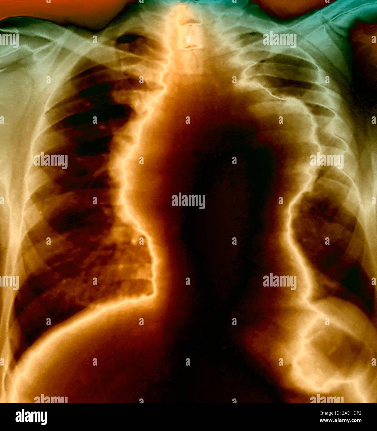 NonHodgkin's lymphoma (NHL), coloured chest X ray. There is a swollen