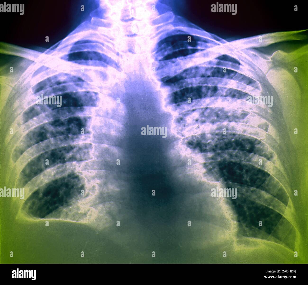 Lung cancer. Coloured chest Xray of a patient with miliary lung cancer. There are many small