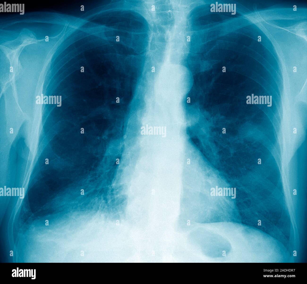 Lung cancer. Coloured Xray showing cancer (grainy area at centre right