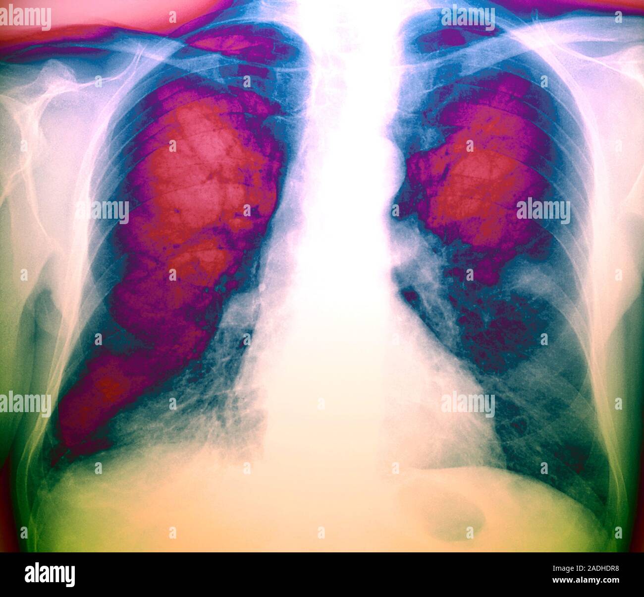 Lung cancer. Coloured Xray showing cancer (grainy area at centre right