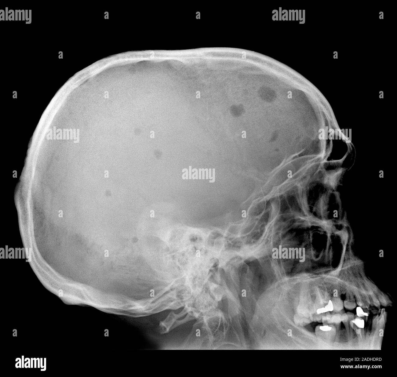 Bone marrow cancer. Xray of the skull of a patient with myeloma (bone marrow cancer). Malignant