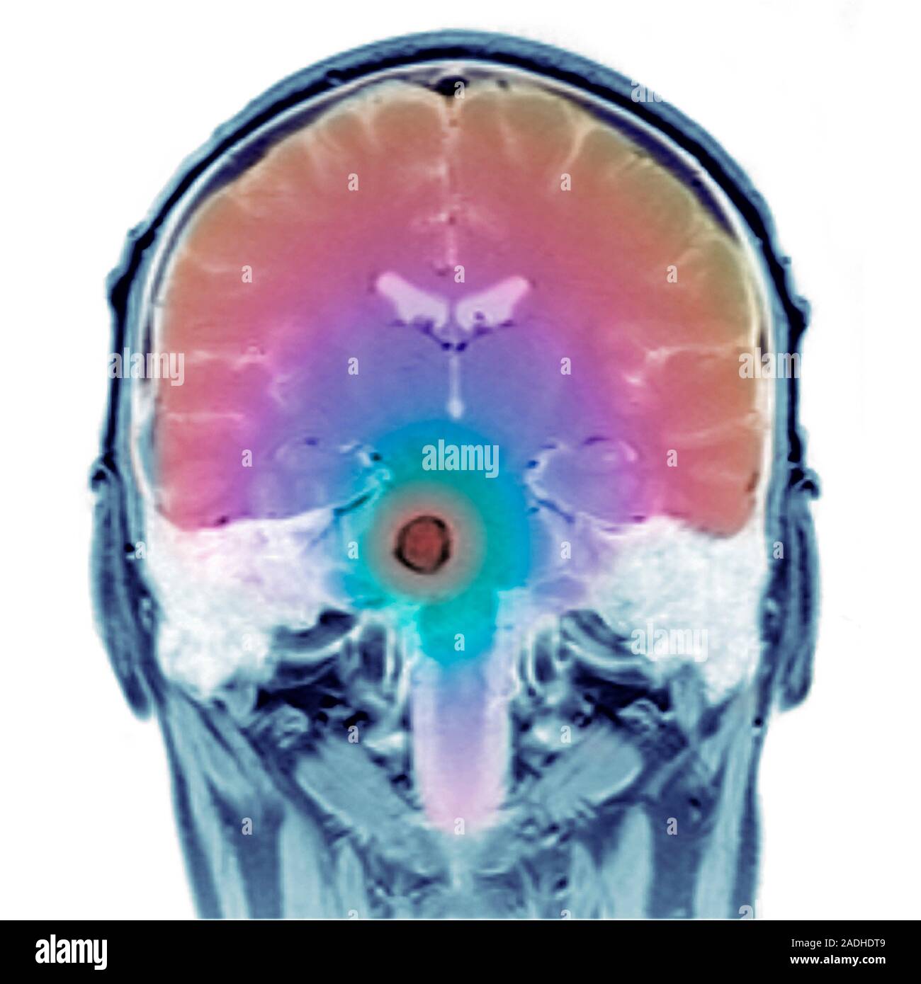 Brain tumour. Coloured magnetic resonance imaging (MRI) scan of a ...