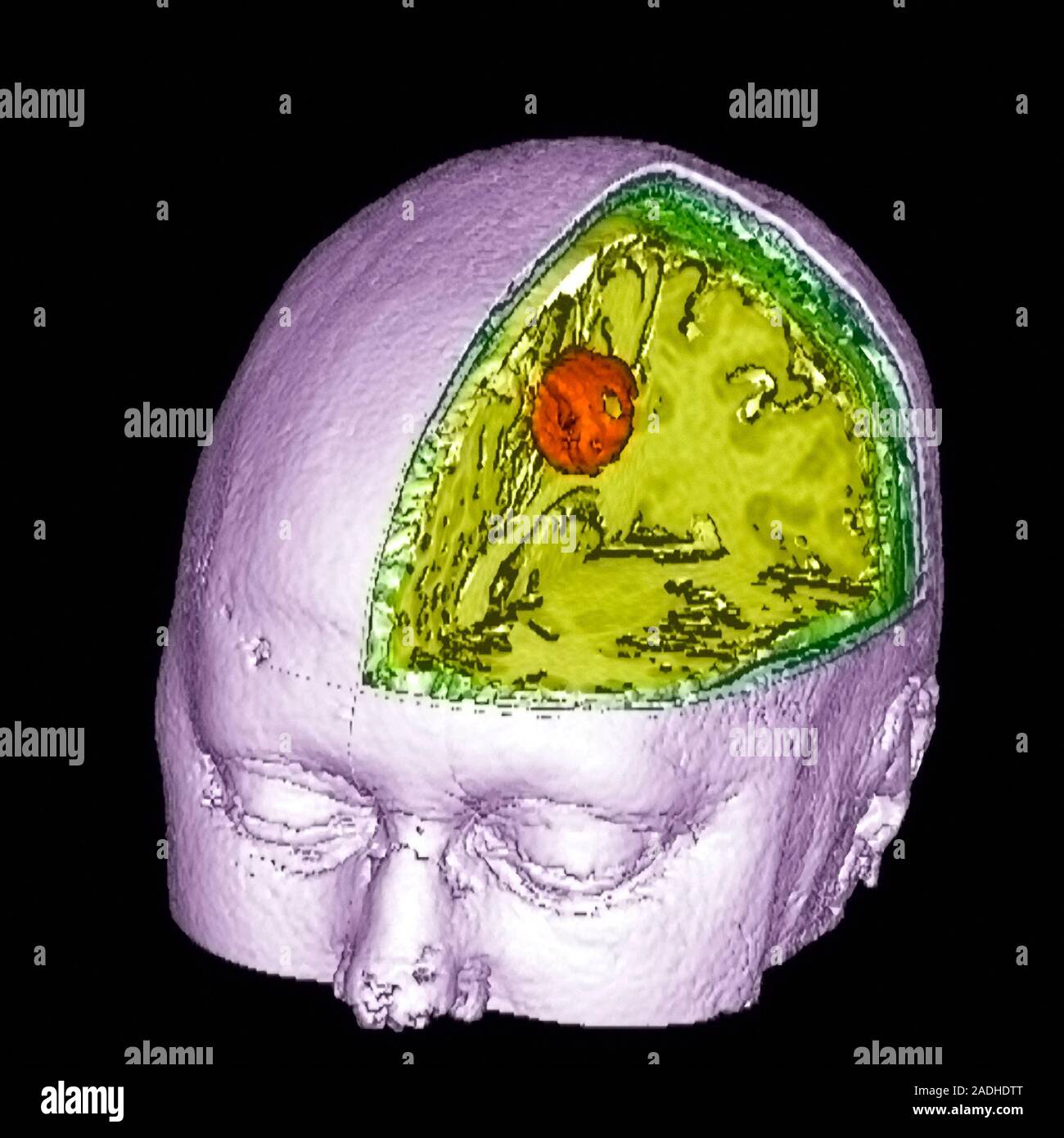Brain tumour. Coloured three-dimensional model of the head of a 43 year ...