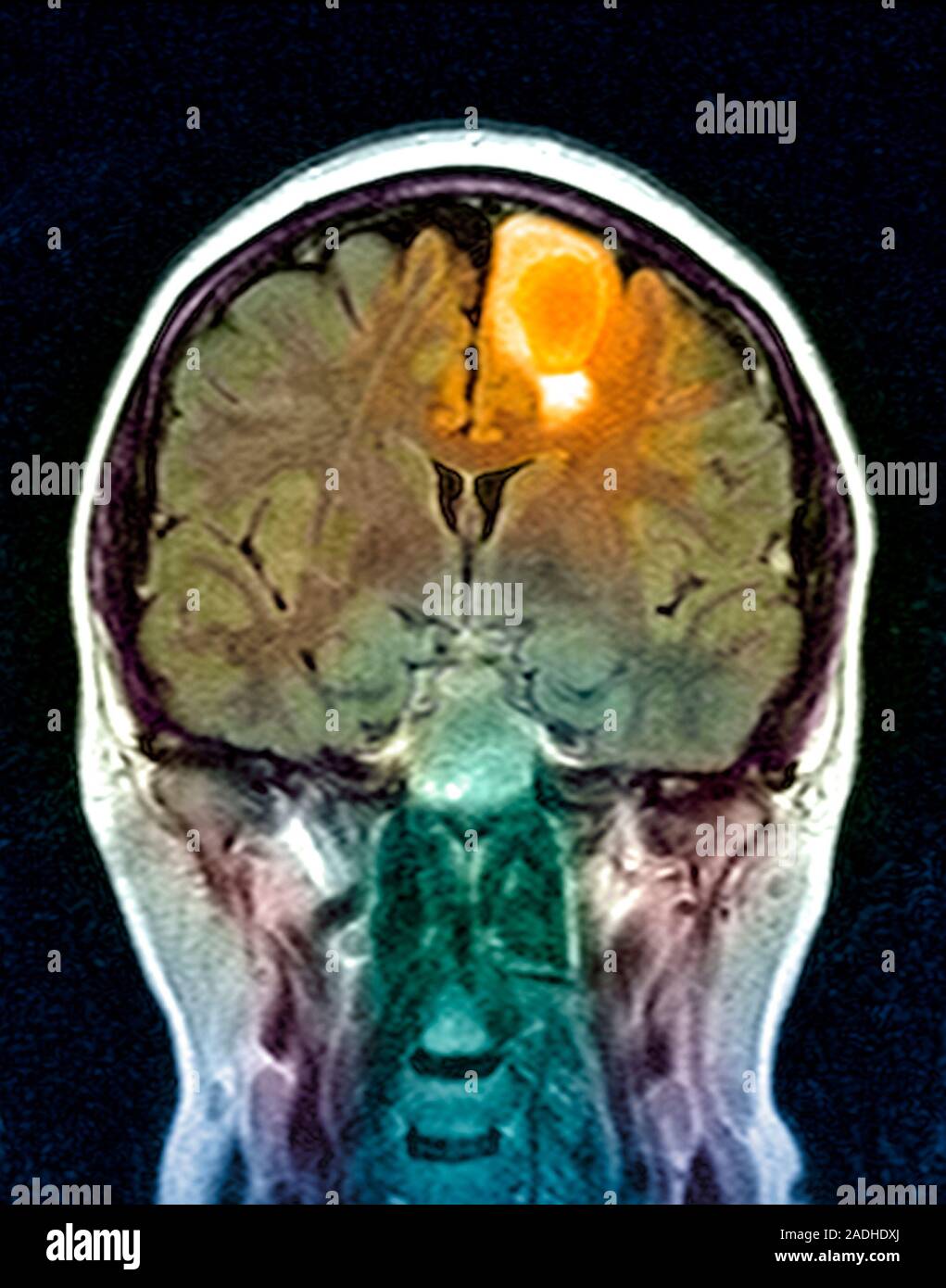 Brain tumour. Coloured magnetic resonance imaging (MRI) scan of a ...