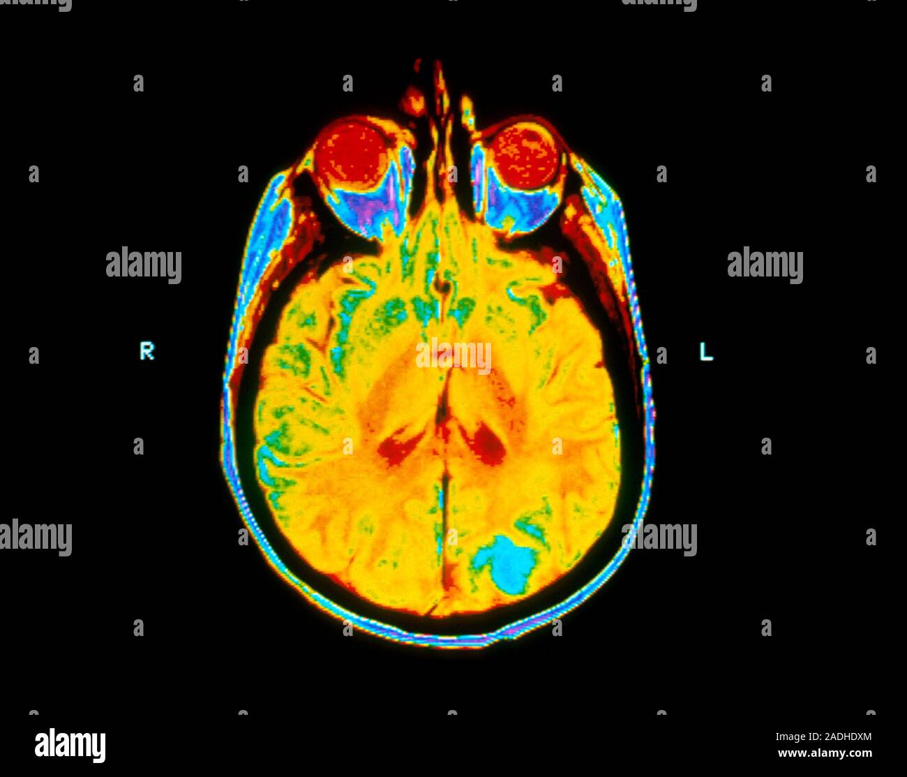 Secondary brain cancer. Coloured magnetic resonance imaging (MRI) scan ...