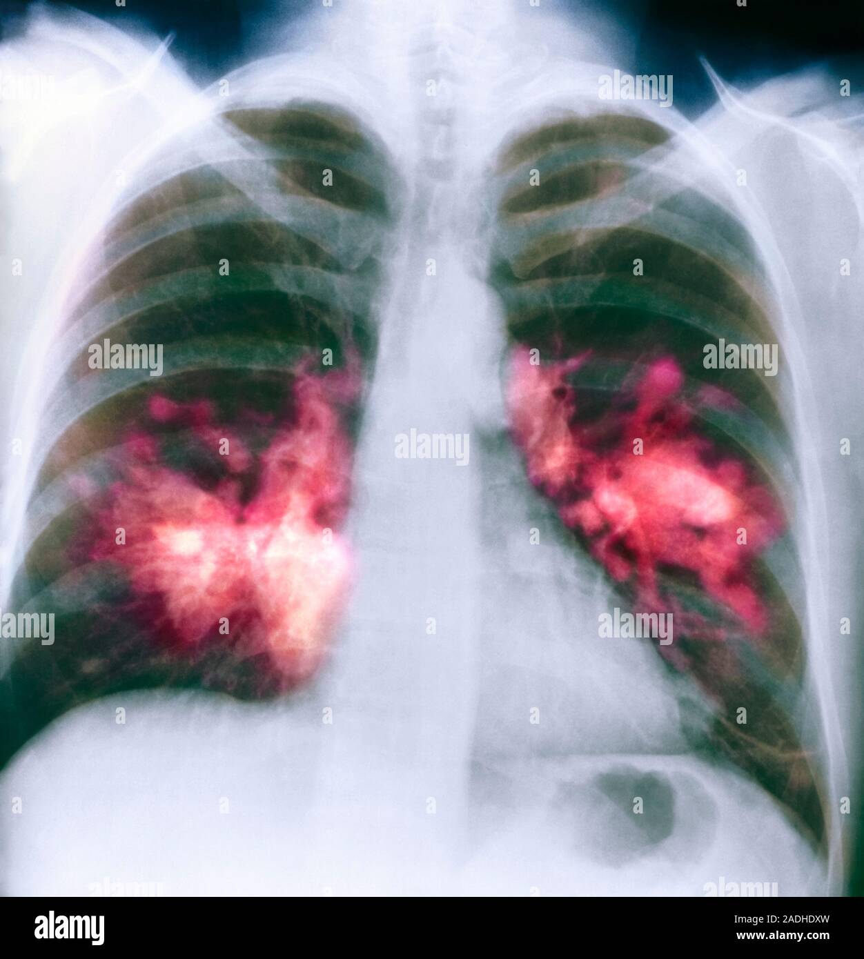 Lung cancer. Coloured X-ray showing growths (pink) in both lungs that ...