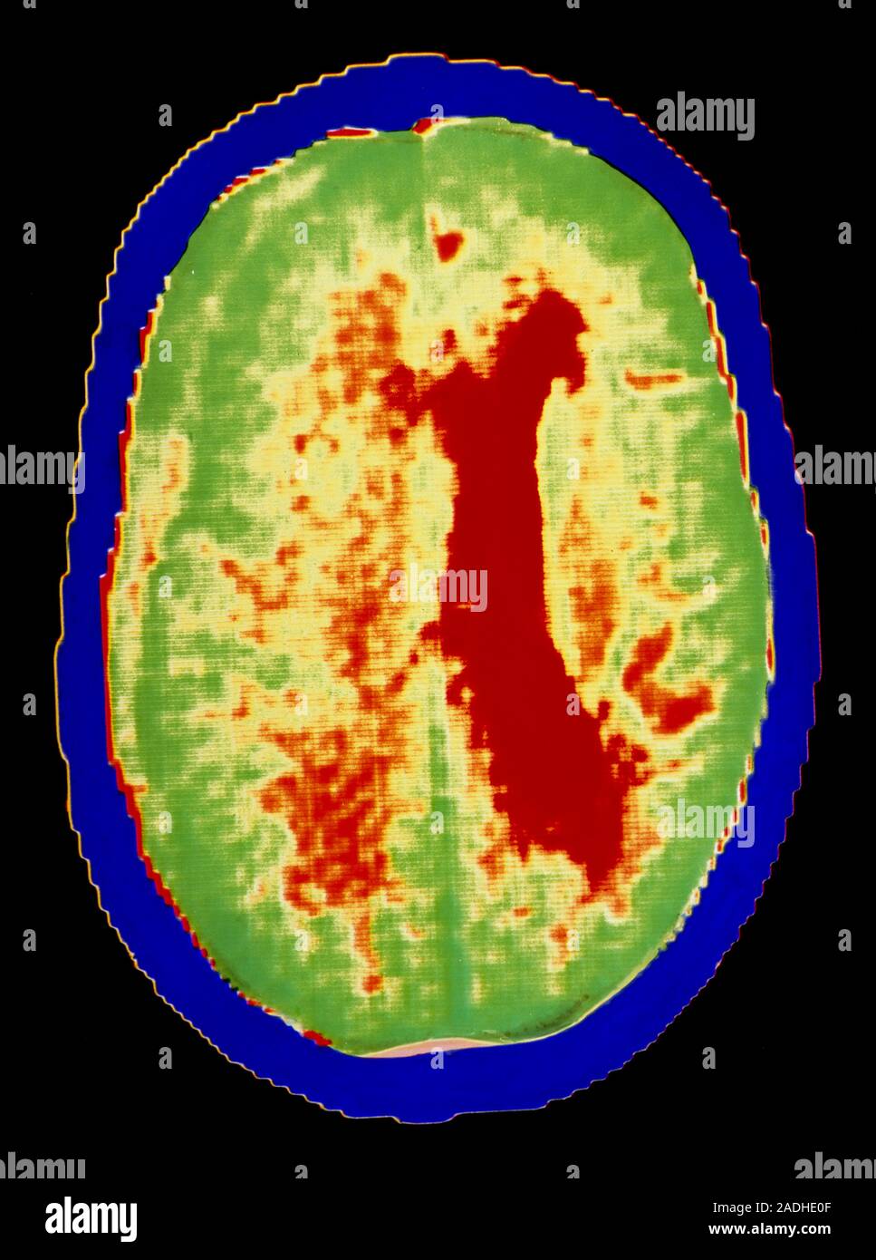 False-colour computed tomography (CT) scan of the brain of a 79 year ...