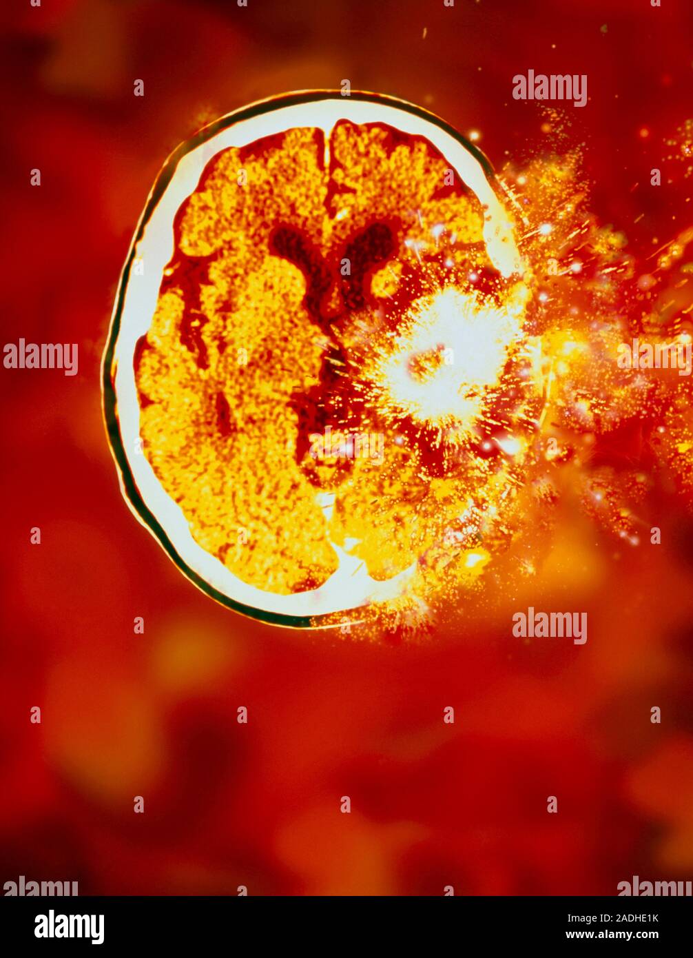 Brain malfunction. Computer artwork depicting an exploding brain in a ...