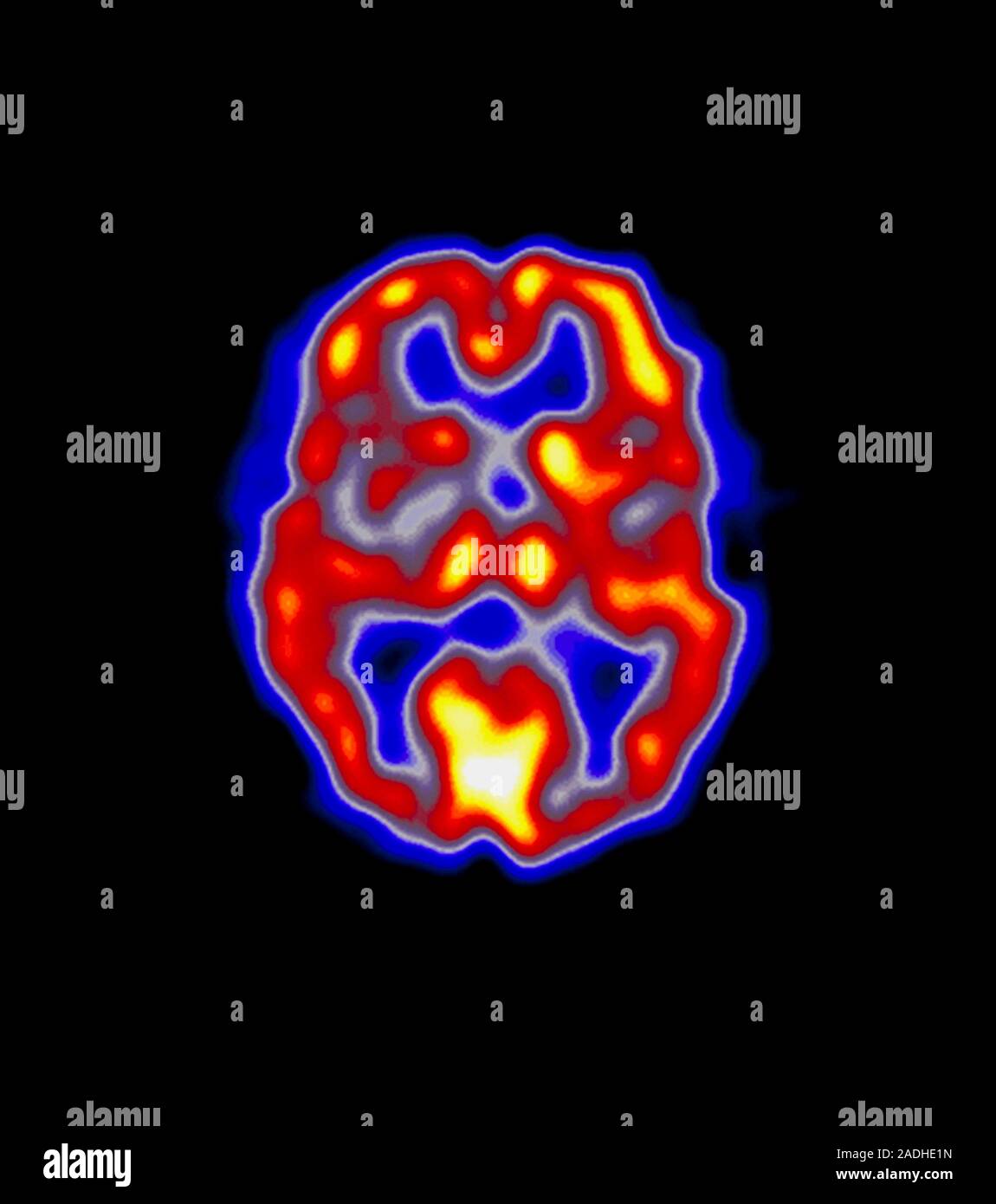 Stroke. Coloured Positron Emission Tomography (PET) scan of the brain ...