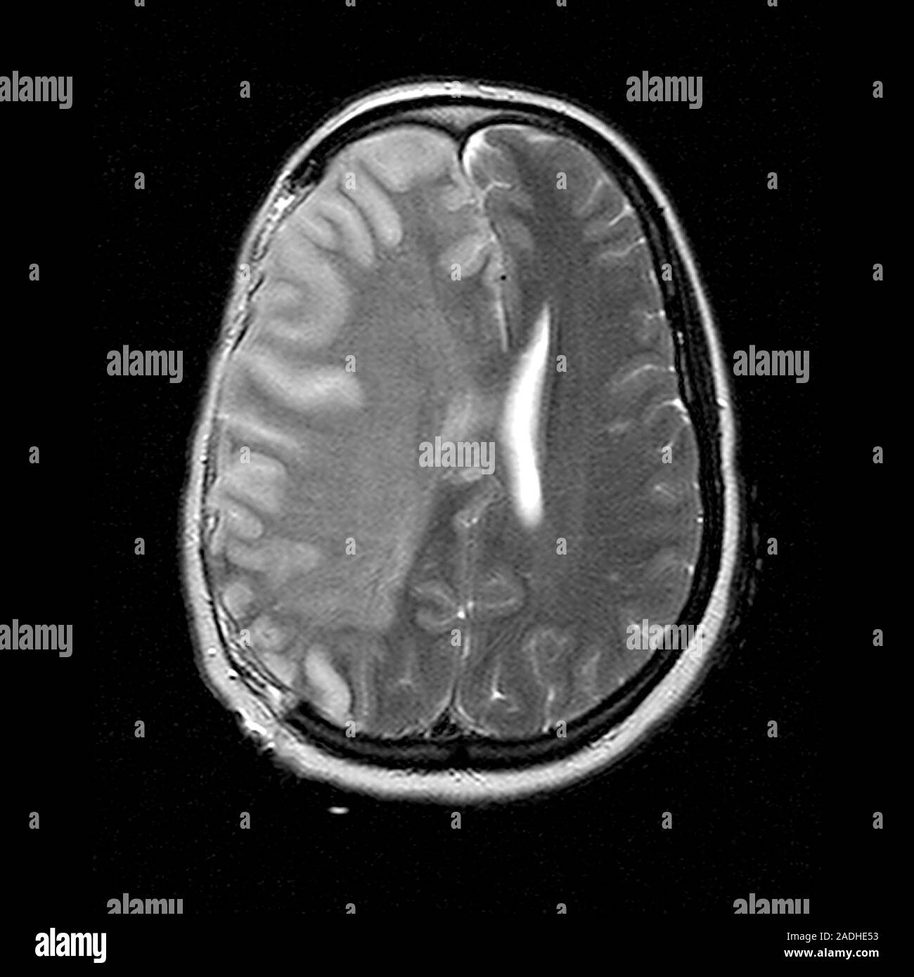 Stroke. Magnetic resonance imaging (MRI) scan of the brain of a 32 year ...