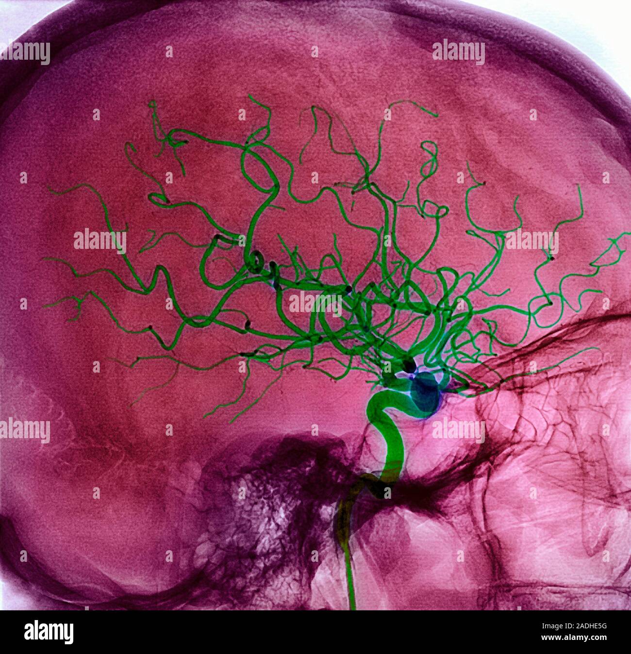 Мозговое кровообращение сердце. Пиальные сосуды головного мозга. Кровеносные сосуды головного мозга человека. Нарушение кровообращения головного мозга. Кровеносная система мозга.