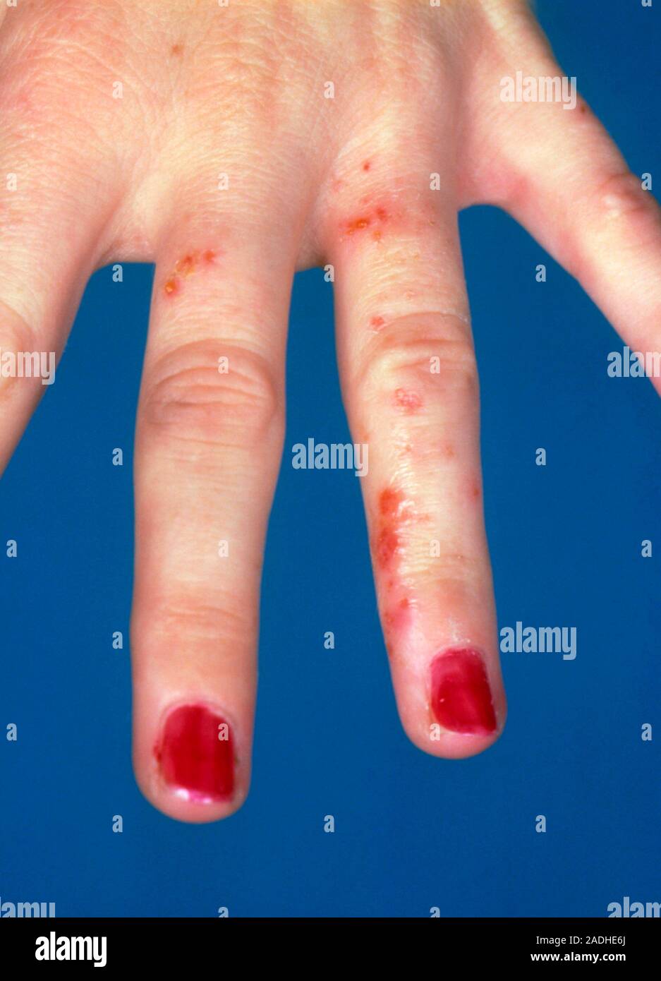 Ordinary Photograph Showing Contact Dermatitis Affecting The Skin