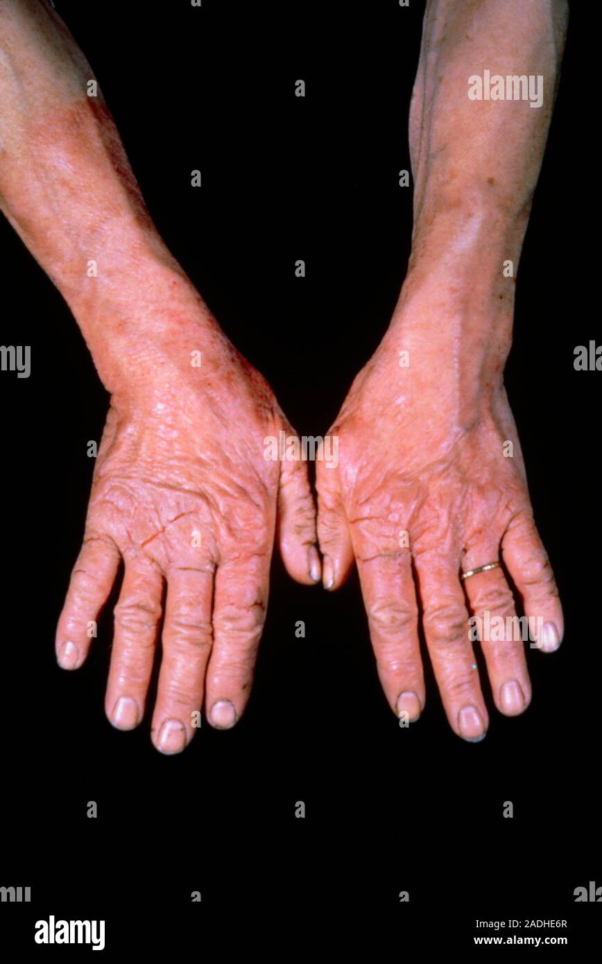Dermatitis of the hands caused by rubber gloves. Dermatitis is a term used  to describe the inflammatory reactions of the skin to external agents, as d  Stock Photo - Alamy