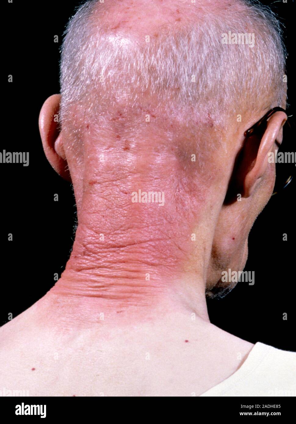 Contact (skin) dermatitis, a form of eczematous dermatitis, seen here
