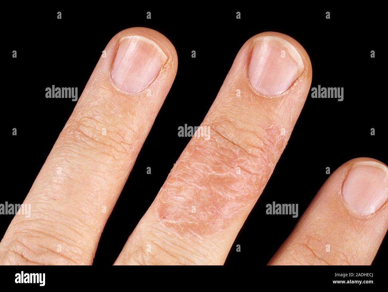 Contact dermatitis. View of a rash (lower centre) on a finger due to