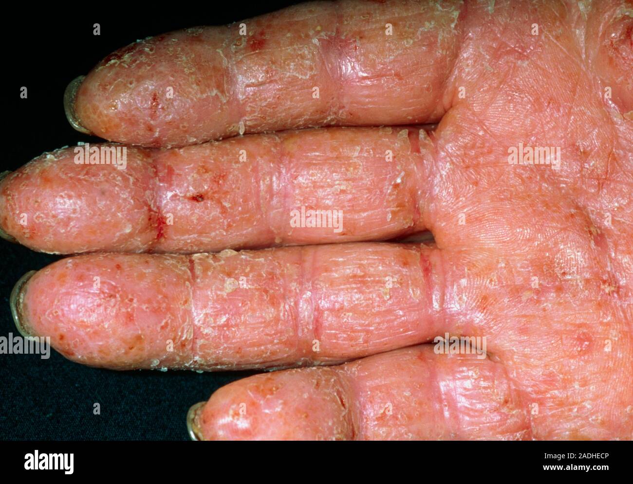 Contact dermatitis. Hand of a 70 year old man affected by contact