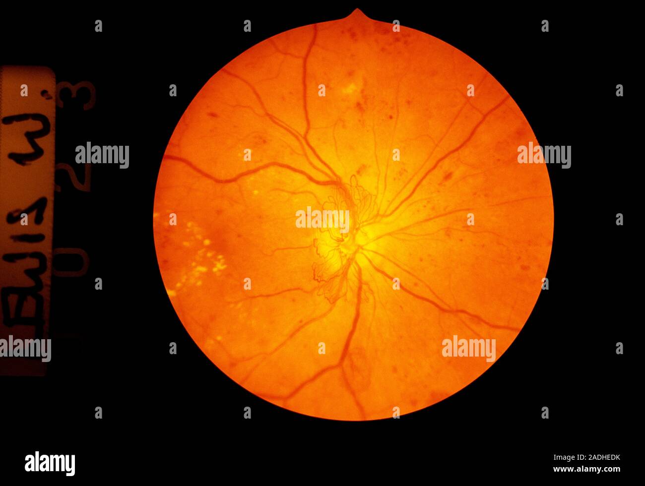 Retinal damage in diabetes. Ophthalmoscope image of diabetic