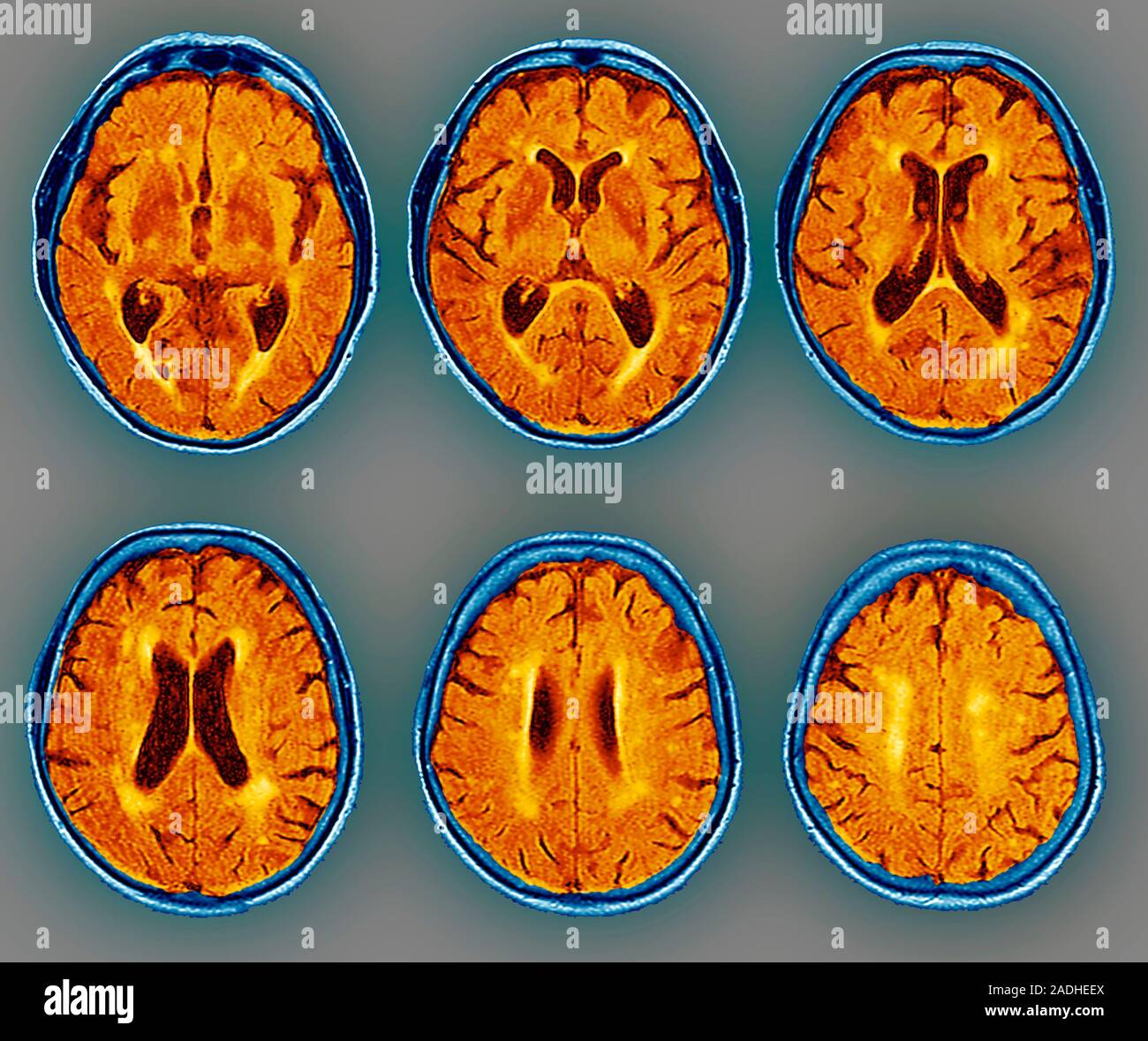 Dementia. Coloured magnetic resonance imaging (MRI) scans of the brain ...