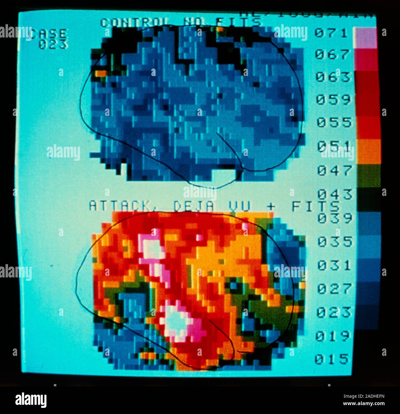False colour scintigram (gamma camera scan) comparing density of blood ...