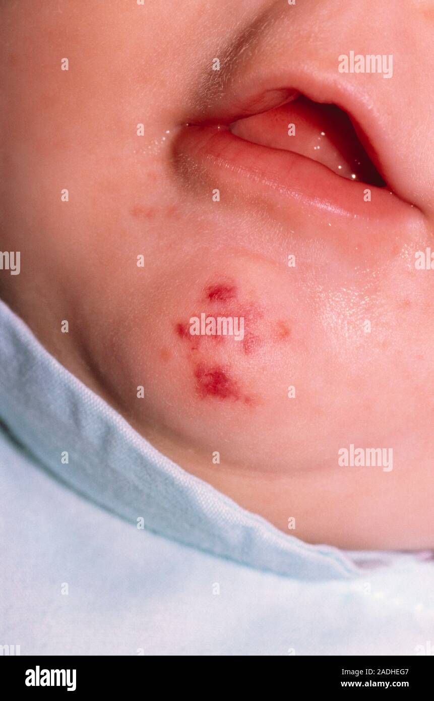 Eczema rash on a baby's chin where the skin has been irritated by