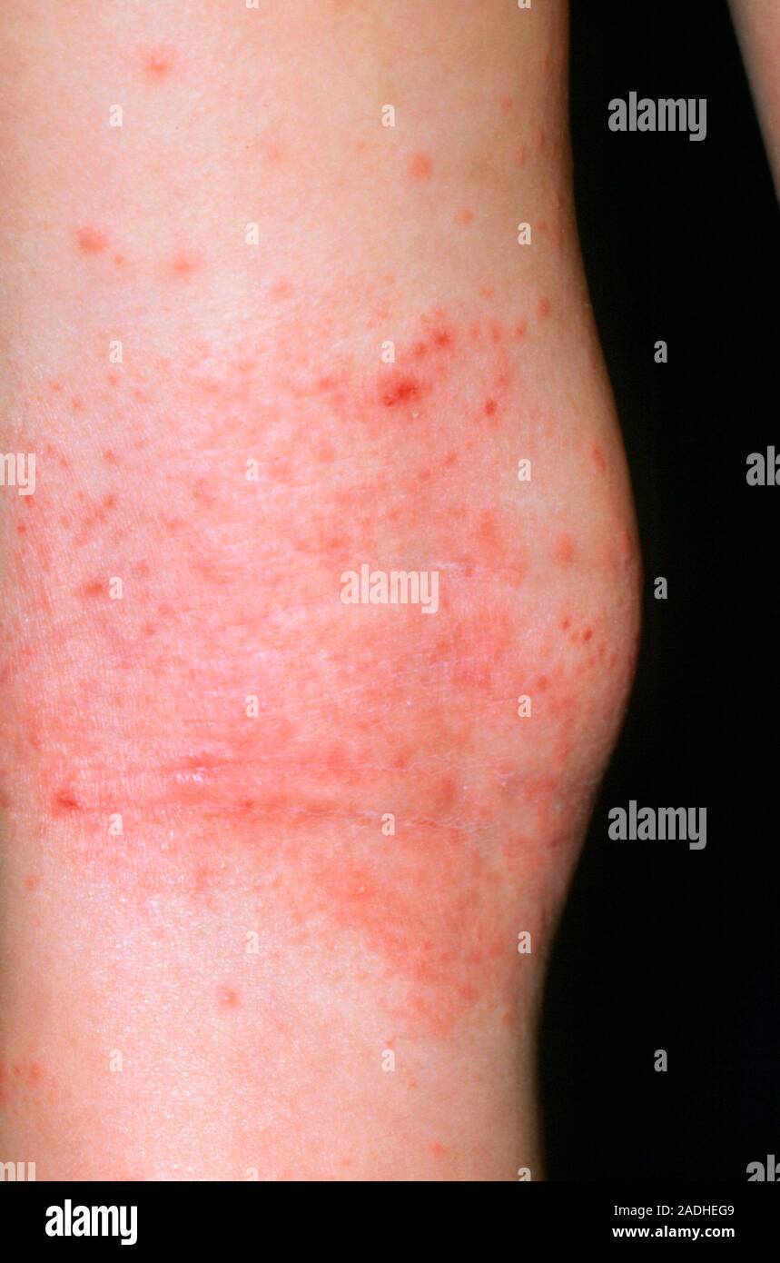 Eczema rash on a child's knee. Eczema is a superficial inflammation of the skin, mainly