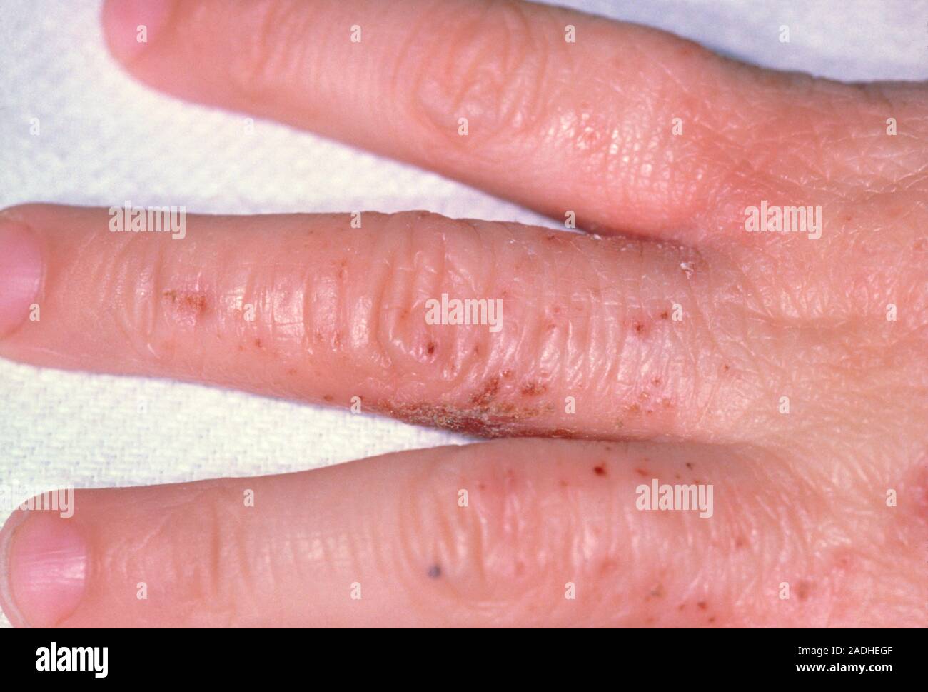 Atopic eczema. Eczema rash on a child's hand. Eczema is a superficial
