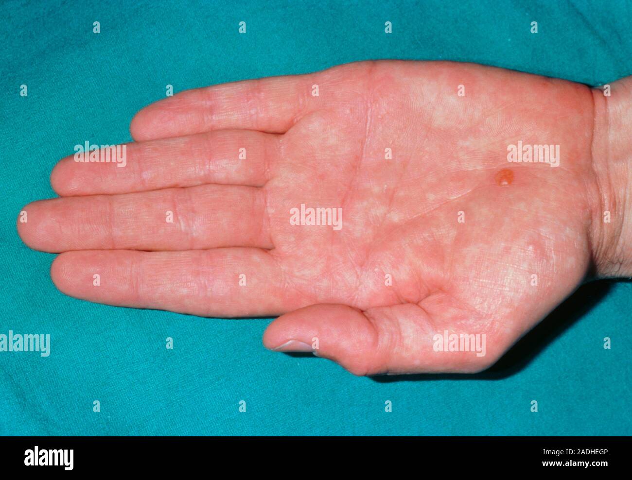 gabapentin itchy palms