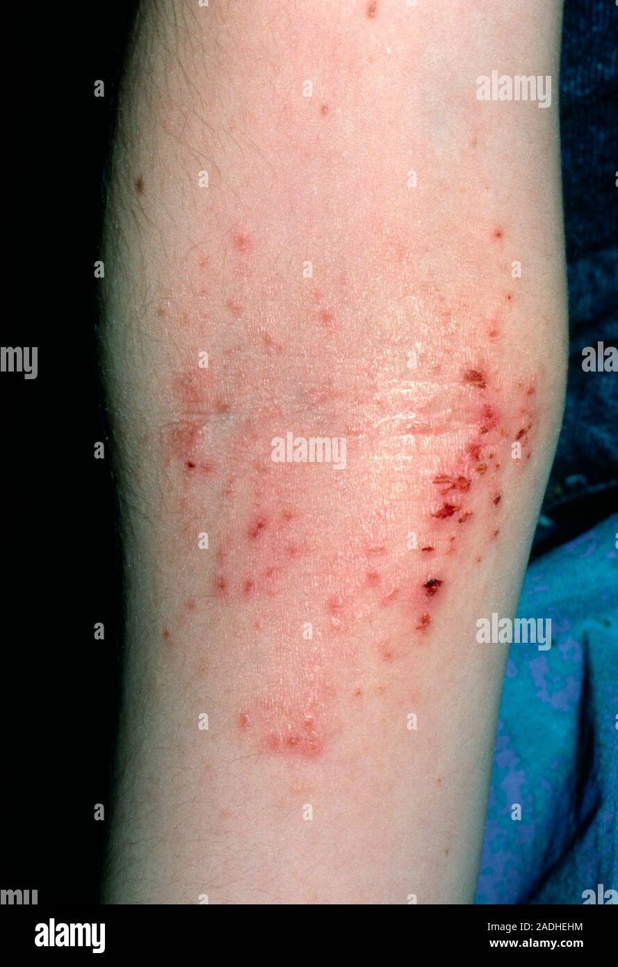 Atopic eczema on the elbow. Closeup of atopic eczema in the crook of