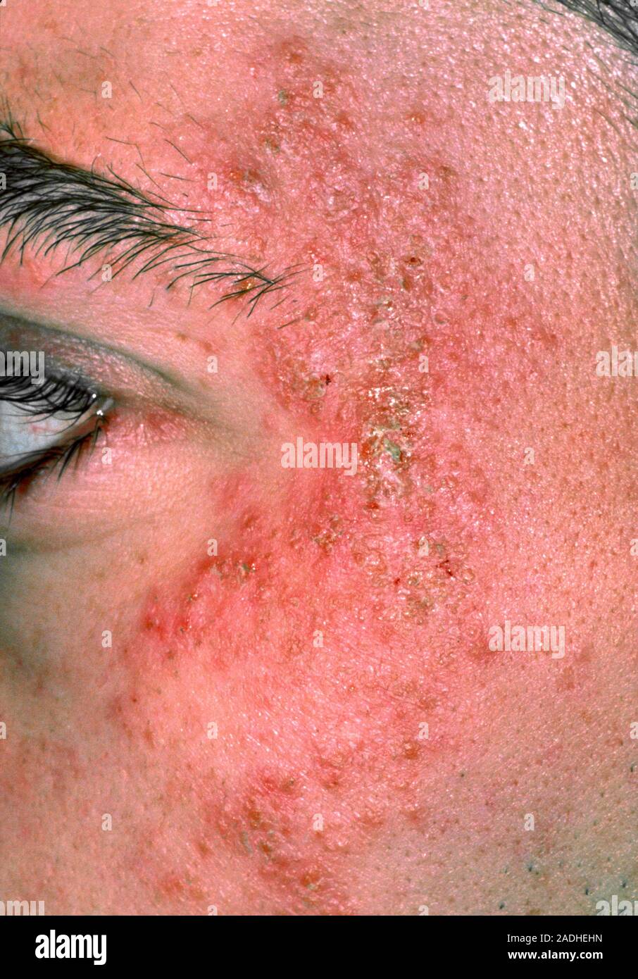 Eczema on a man's face. Closeup of an eczema rash on the side of a man