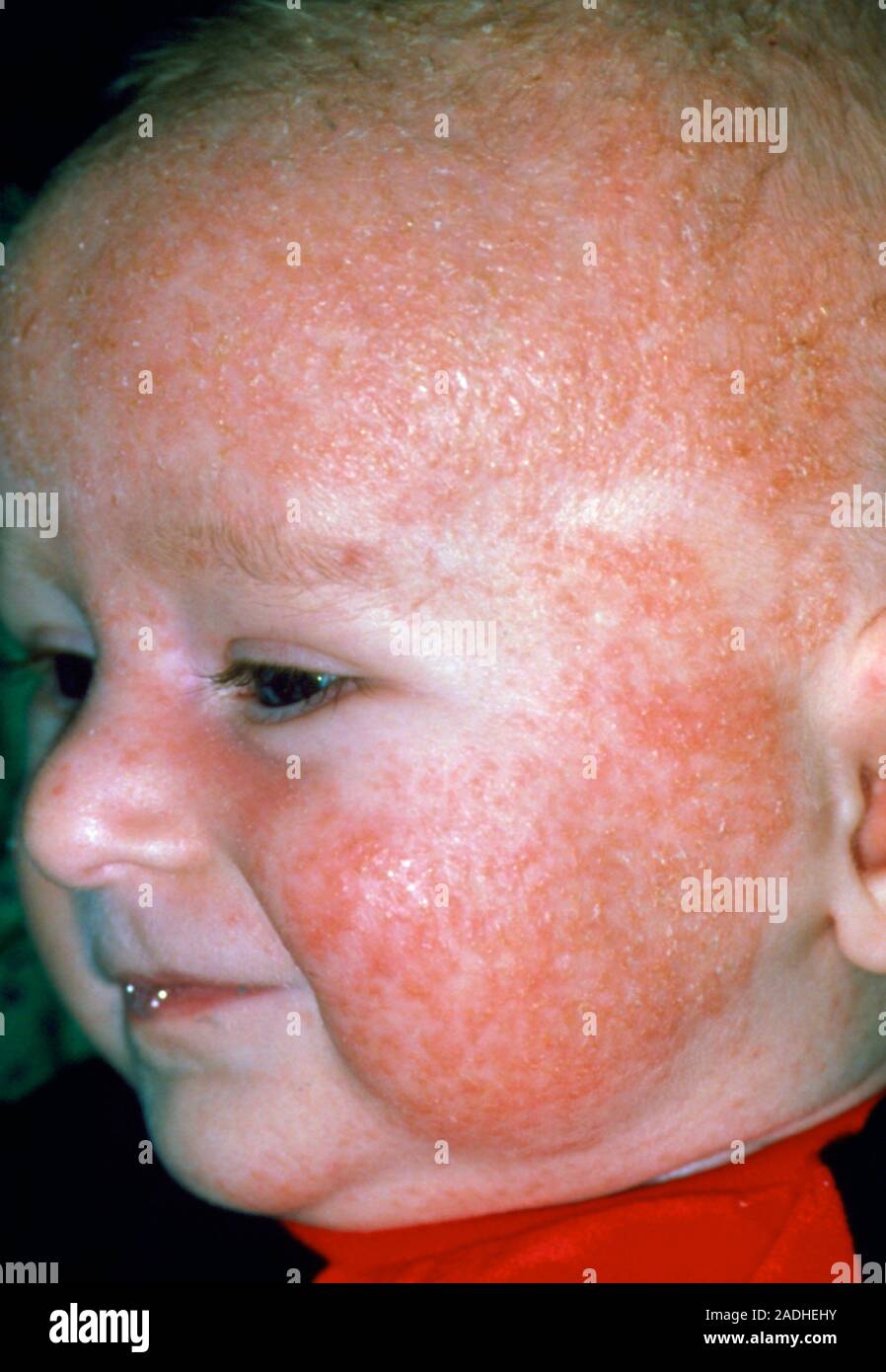 Eczema. An eczema rash covering most of the skin on a baby's face and