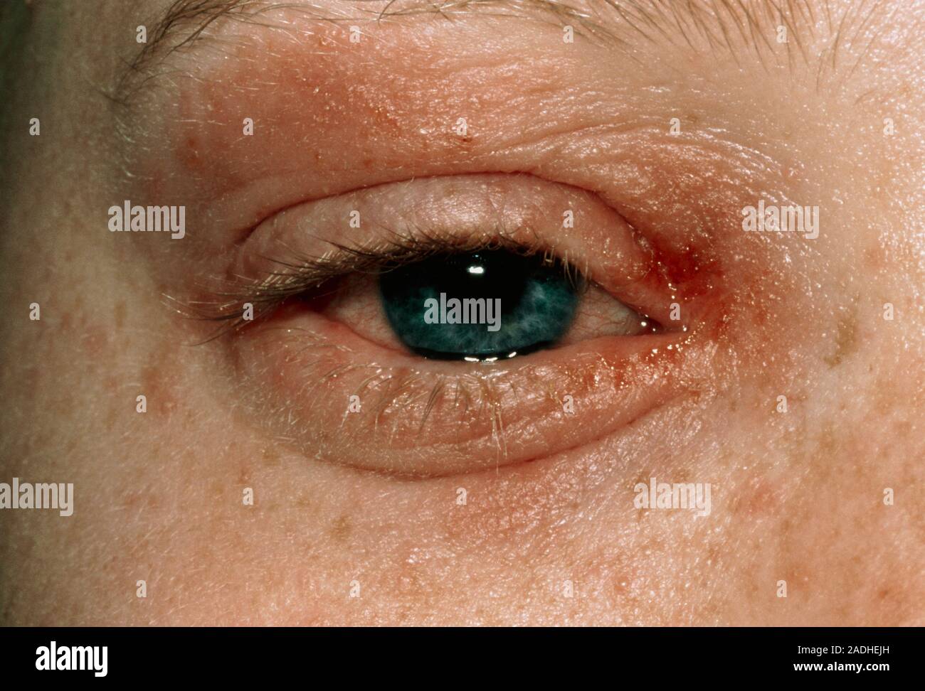 Eczema around eye. Closeup of an eczema rash on the skin around the