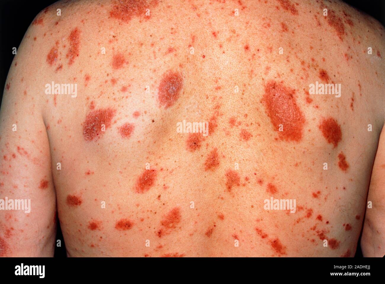 Eczema. View of a patchy red eczema rash seen on the back of a 61 year