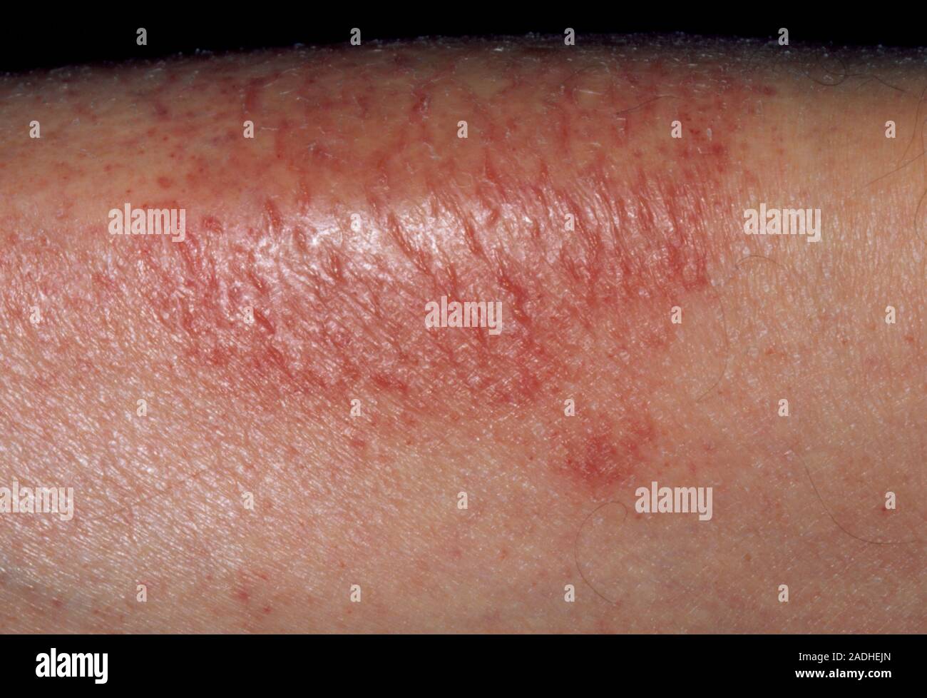 Asteatotic eczema. Closeup of a patch of asteatotic eczema on the leg