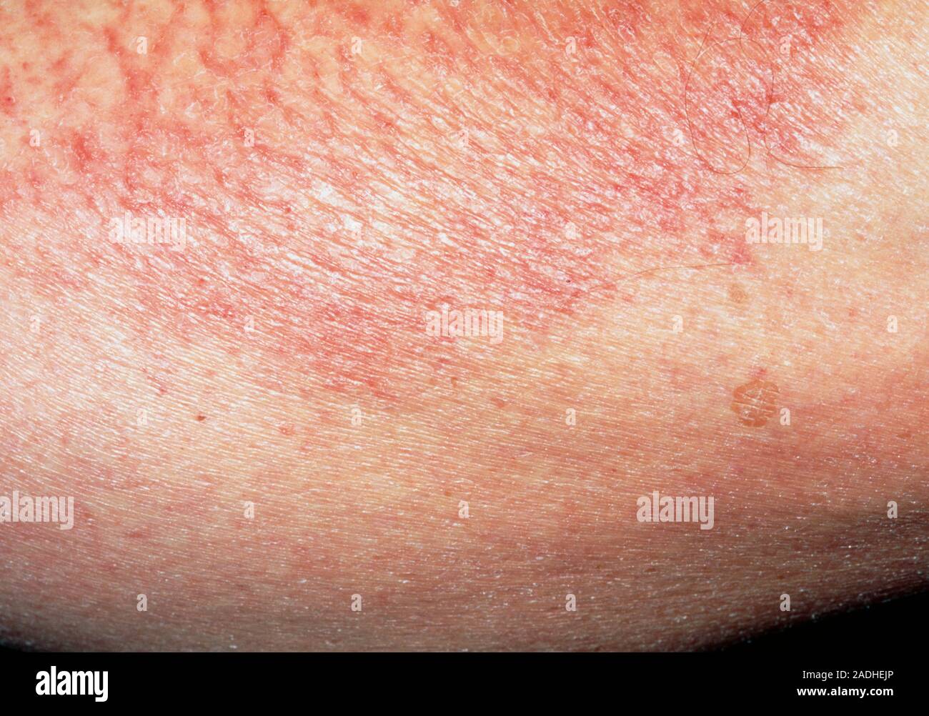 Asteatotic eczema. Closeup of a patch of asteatotic eczema on the skin
