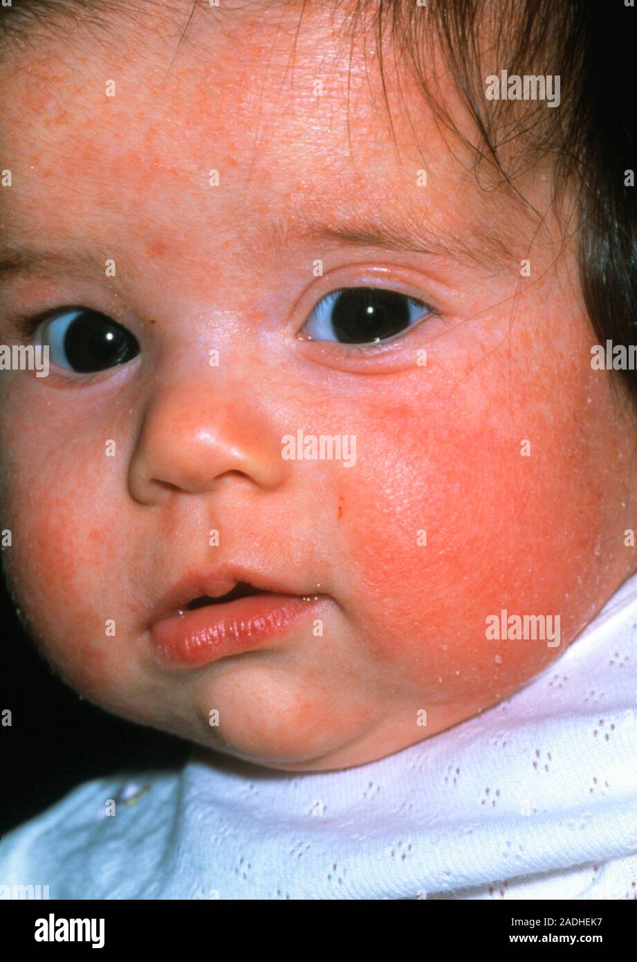 Atopic eczema on the face of a 3 monthold baby girl. The skin is red