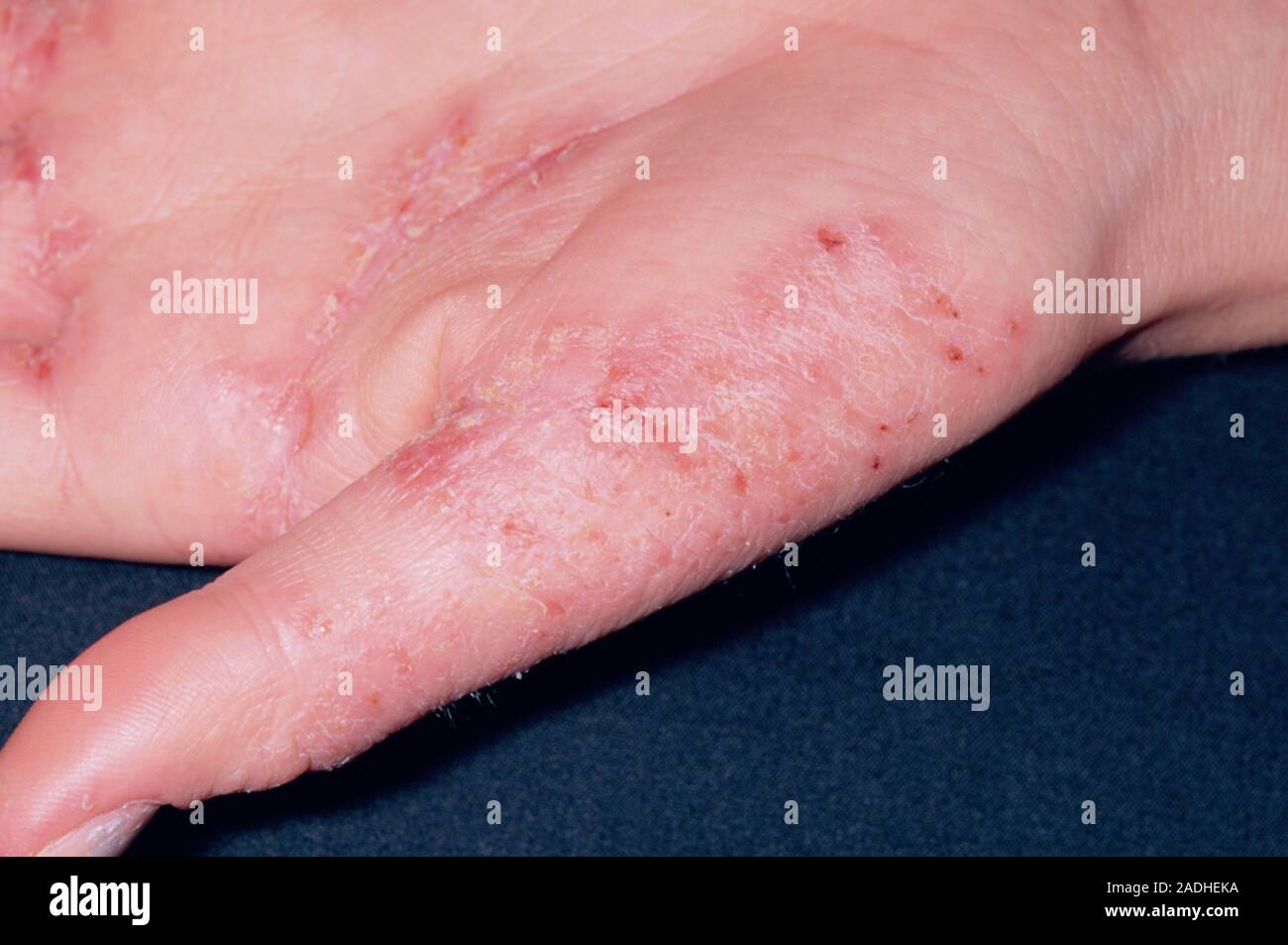 Eczema on the hand of a 15-year-old girl. Eczema is a type of skin ...