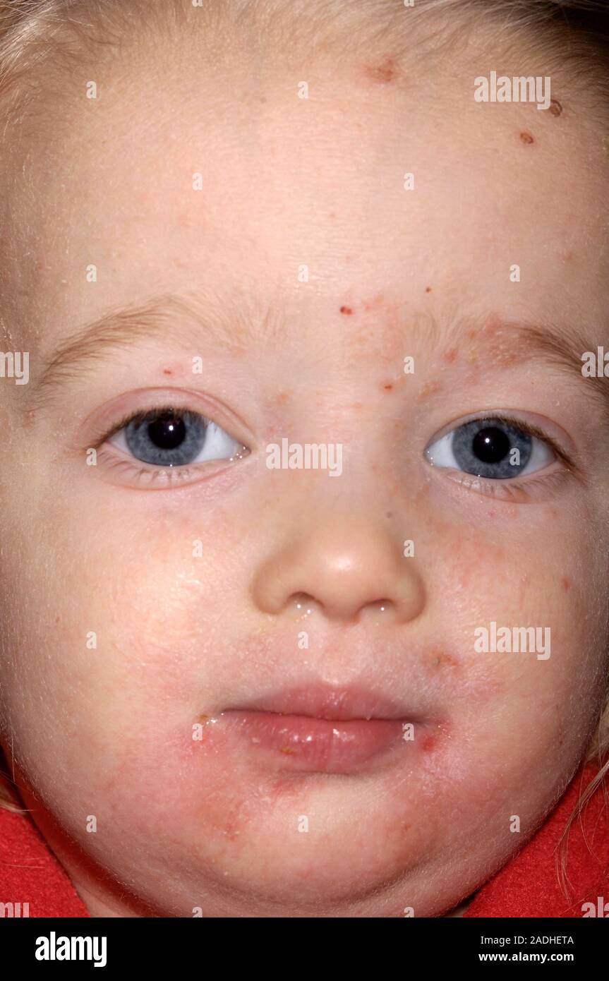 Infected eczema (scaly red lesions) affecting the skin of a 2yearold