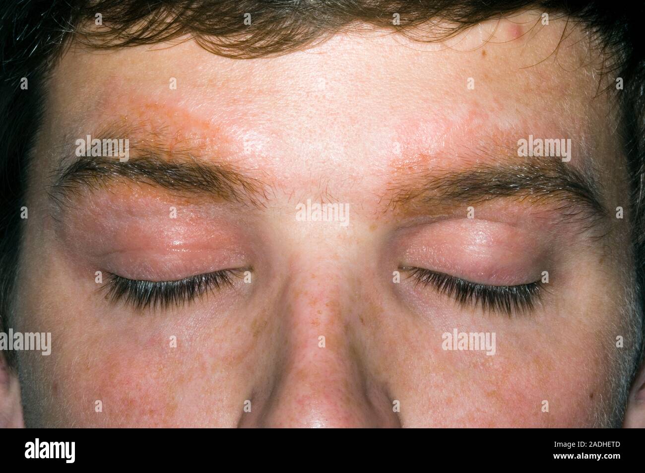 Infected eczema rash in a 21 year old man's eyebrows. Eczema is an