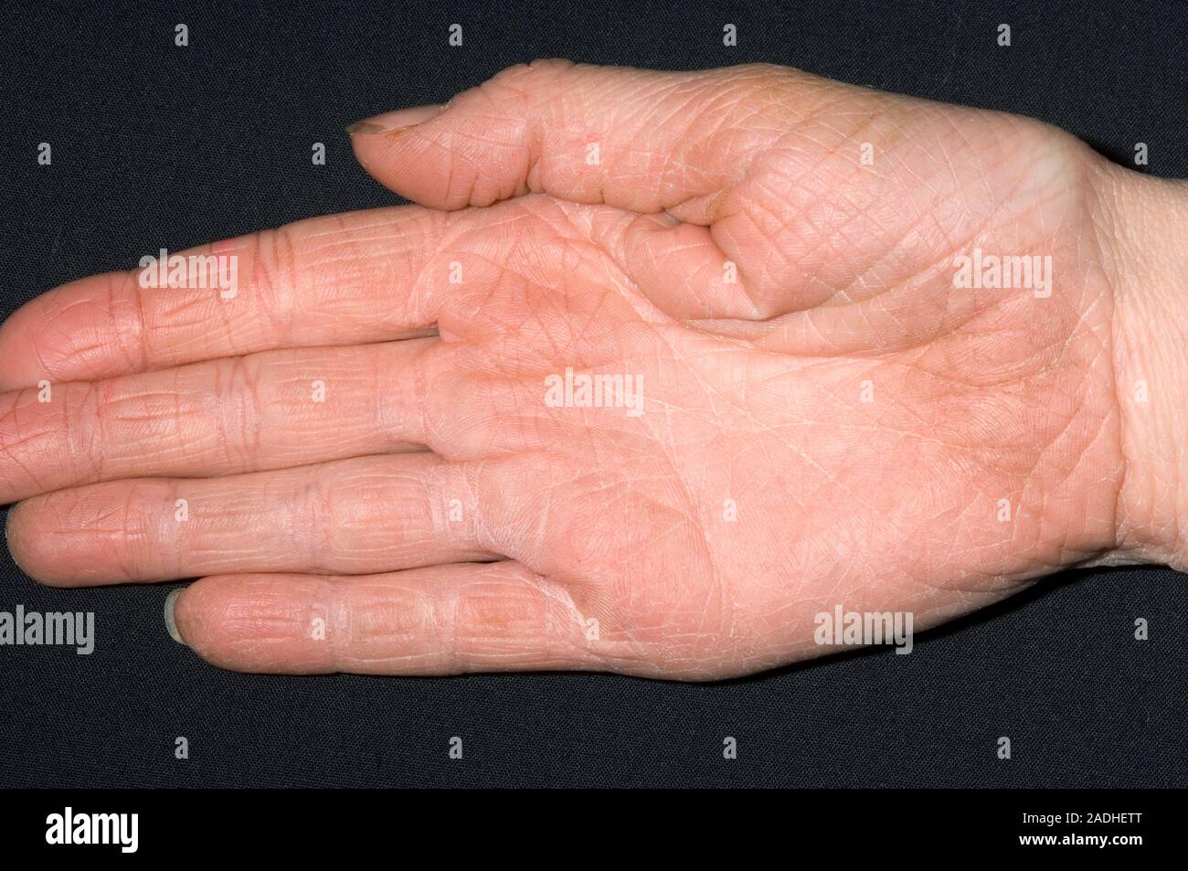 MODEL RELEASED. Eczema on a patient's palm. Eczema is an inflammation