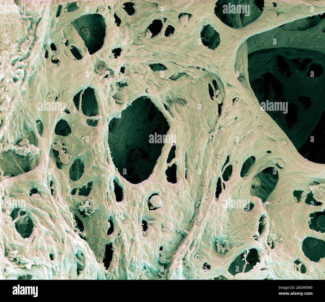 Emphysema. Coloured scanning electron micrograph (SEM) of human lung ...